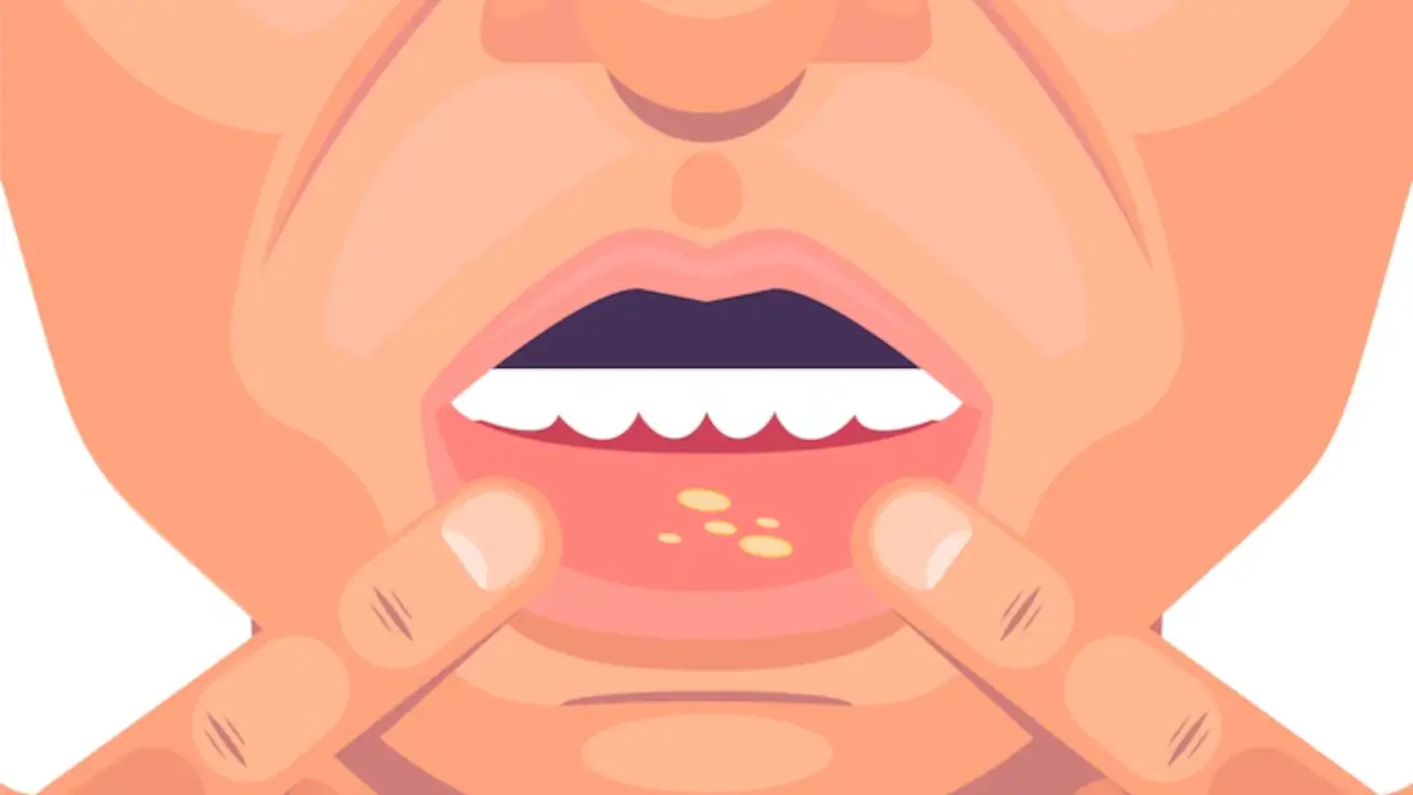 जानिए मुंह के छाले होने के कारण क्या है ? 15 जानिए मुंह के छाले होने के कारण क्या है ?